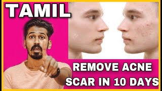 REMOVE ACNE SCAR IN 10 DAYS  TAMIL  HOUSE OF MAVERICK [upl. by Drusilla]