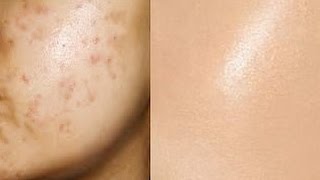 Remove Acne Marks  3 Step  Natural Remedies for Pimple Marks   Prachi SuperWowStyle [upl. by Innus]