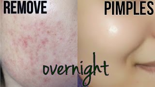 How To Remove Pimples Overnight  Acne Scar Treatment [upl. by Charisse916]