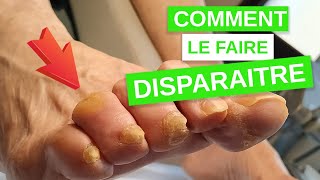 Comment faire disparaître un cor aux pieds [upl. by Melli871]