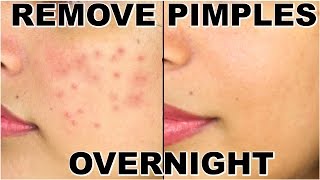 How To Remove Pimples Overnight  Acne Treatment  ShrutiArjunAnand [upl. by Schacker]