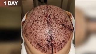 FUE Hair Transplant Timeline I Day 1 to Day 365 [upl. by Bergman710]