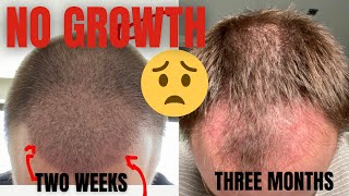 Hair Transplant 3 Months NO GROWTH [upl. by Atkins]