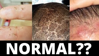 These 3 Things Are Normal After A Hair Transplant [upl. by Bore784]