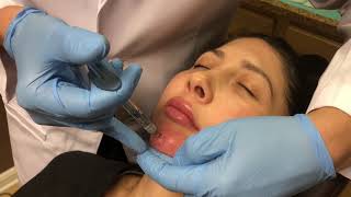 NonSurgical Chin Augmentation using Juvederm Voluma 3cc [upl. by Dnomal266]