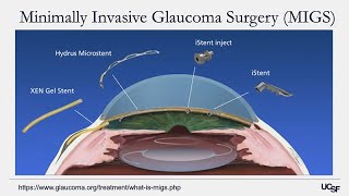 What is Glaucoma and Intraocular Pressure [upl. by Servetnick773]