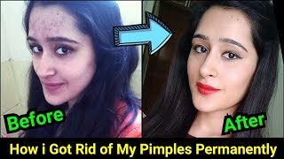 How to Remove Pimples Acne Pimple Marks completely  ThatGlamGirl [upl. by Indys]