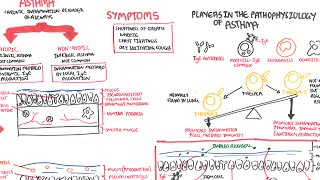 Asthma  signs and symptoms pathophysiology [upl. by Saffren]