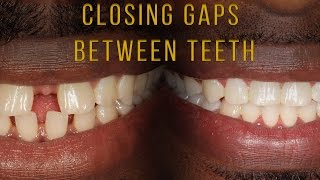 Closing Gaps Between Teeth With Braces [upl. by Wachtel]