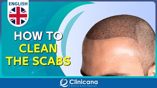 How to clean the scabs after 11 days from the hair transplant operation [upl. by Nostaw]