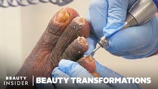 How Medical Pedicures Transform Feet [upl. by Shivers]