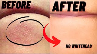 How To Remove Whiteheads And Blackheads From Chin At Home [upl. by Bostow128]