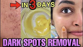 Remove DARK SPOTS NATURALLY in 3 Days 😍 Hyperpigmentation Acne Scars Brown Spots [upl. by Drue]