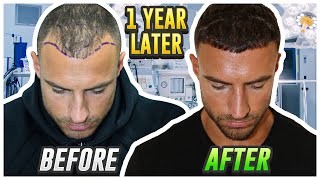 My Hair Transplant Results After 1 Year [upl. by Sanferd]