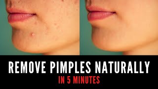 How To Remove Pimples Naturally At Home  Remove Pimples In 5 Minutes  Skin Care  Voguenyog [upl. by Cirdnek805]