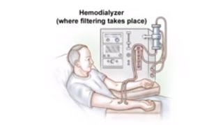 Dialysis Access and Fistula Procedure [upl. by Kezer]