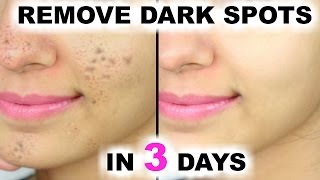 In 3 DAYS  Remove DARK SPOTS BLACK SPOTS amp ACNE SCARS  Anaysa [upl. by Pauwles396]