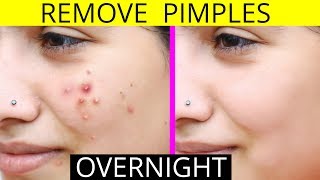 How To Remove Pimples Overnight  Acne Treatment  Anaysa [upl. by Adoc]