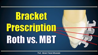 Using Roth and MBT brackets [upl. by Akli]