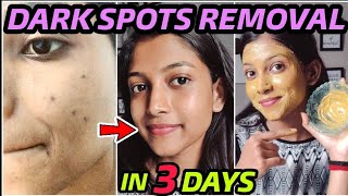 Remove DARK SPOTS NATURALLY in 3 Days 😍 Hyperpigmentation Acne Scars Brown Spots [upl. by Daub]