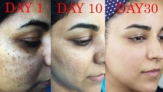 How I Got Rid of Dark Scars Hyperpigmentation PimplesAcne [upl. by Irap]