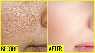 How to Get Rid of Large OPEN PORES Permanently  Anaysa [upl. by Ahsemat]