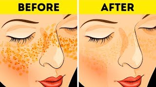 How to Get Rid of Acne Scars In Just 3 Days [upl. by Nylodnew]