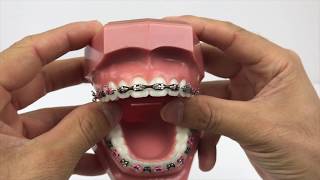 How Do Braces Close Gaps Between Teeth 2018 [upl. by Enalahs]