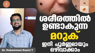 ശരീരത്തിൽ ഉണ്ടാകുന്ന മറുക് ഇനി പൂർണ്ണമായും ഒഴിവാക്കാം  Maruk  Mole  Malayalam  Dr Muhammed Razmi [upl. by Vidovic422]