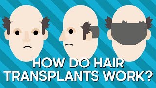 How Do Hair Transplants Work  Earth Science [upl. by Airretal509]