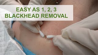 Easy as 1 2 3 Blackhead Removal  Dr Derm [upl. by Nilerual]